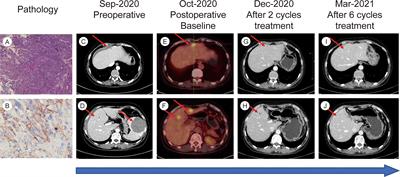 Case Report: Complete Remission With Anti−PD−1 and Anti−VEGF Combined Therapy of a Patient With Metastatic Primary Splenic Angiosarcoma